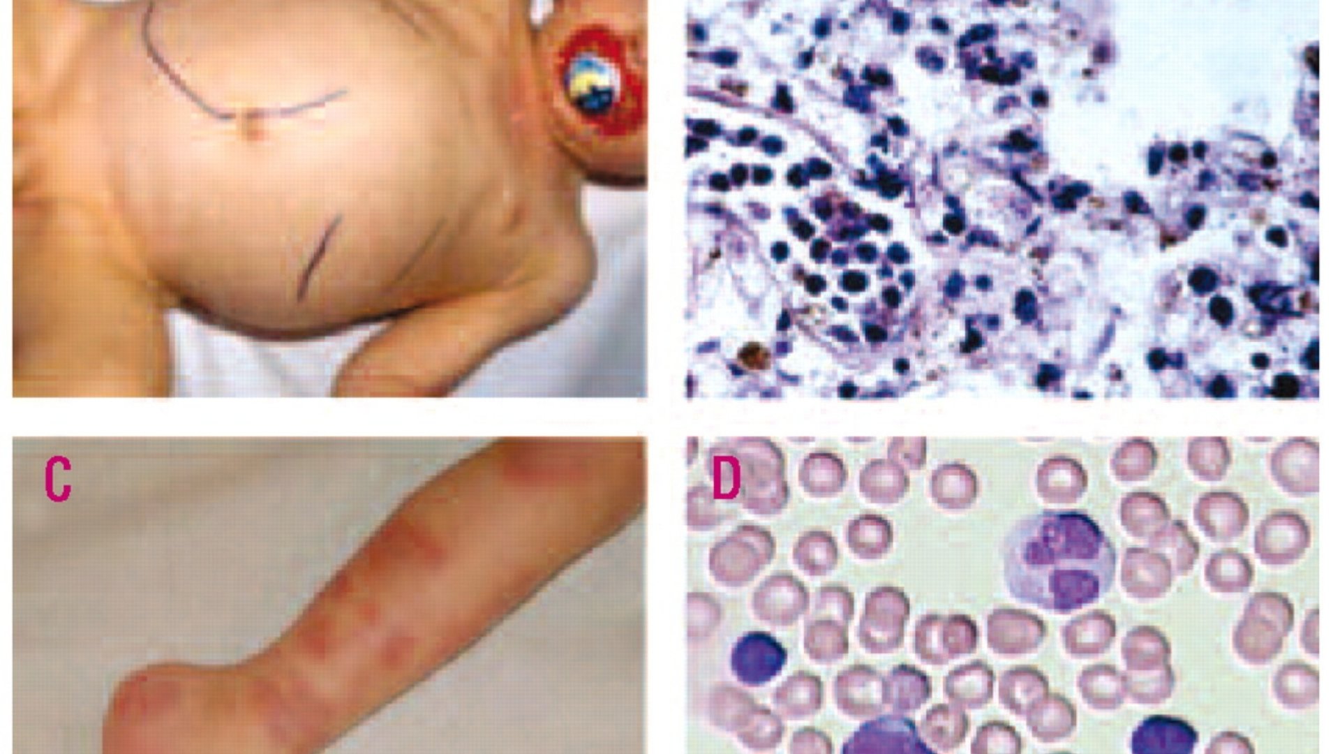 幼年髓單核細胞白血病 JMML