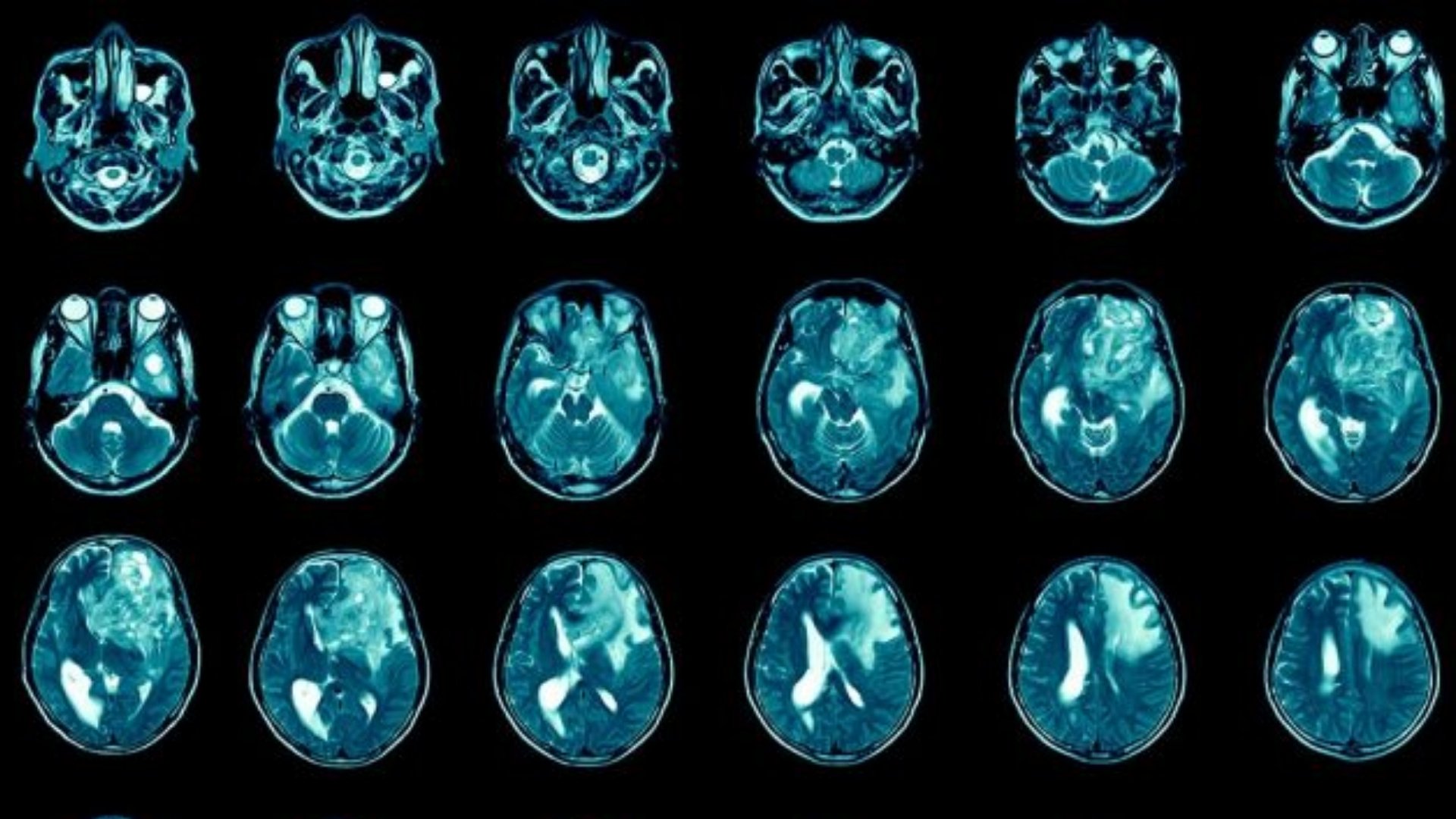 膠質母細胞瘤 (GBM) 1 膠質母細胞瘤 (GBM)